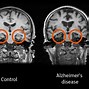 Image result for Alzheimer Brain CT Scan