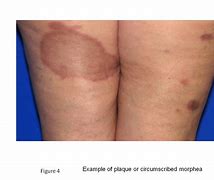 Image result for Localized Scleroderma Morphea