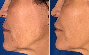 Image result for Nasolabial Fold Filler Before and After