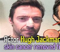 Image result for Hugh Jackman Skin Cancer On Nose