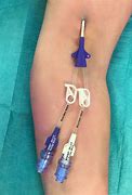 Image result for PICC Line Catheter Placement