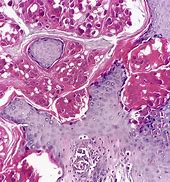 Image result for Molluscum Contagiosum Virus Structure