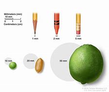 Image result for How Big Is 5 Cm Tumor
