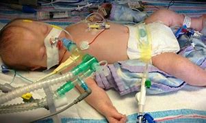 Image result for Boy On Life Support for Life