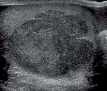 Image result for Testicular Cancer Tumor Size