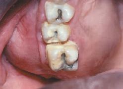 Image result for Calcifying Odontogenic Cyst