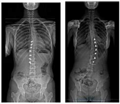 Image result for Tethering for Scoliosis