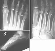 Image result for Metatarsal Stress Fracture XR