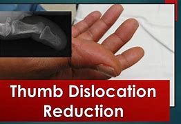 Image result for Dislocating Thumb Meme