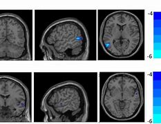 Image result for Schizophrenic Brain vs Healthy Brain