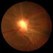 Image result for ERM Retina