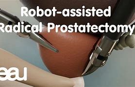Image result for Recovery From Robotic Prostatectomy