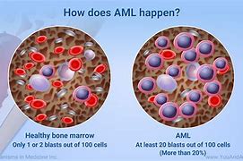 Image result for aml