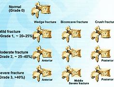 Image result for Vertebral Body Fracture Types