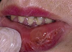 Image result for Syphilis Mouth Ulcer