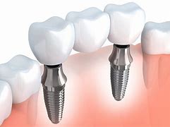 Image result for Dental Implant Bone Loss After