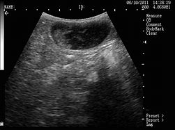 Image result for Fetal Death Maple LifeSign