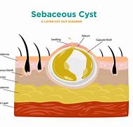 Image result for Sebaceous Cyst Surgery