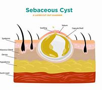 Image result for Sebaceous Cyst Removal