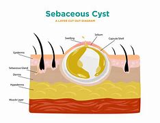 Image result for Sebaceous Cyst Scalp