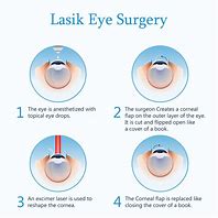 Image result for Lasik Surgery Diagram