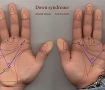 Image result for Down-Syndrom Fingerprint