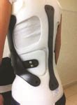 Image result for New Back Brace for Scoliosis