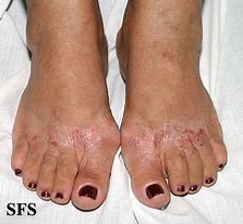 Image result for Contact Dermatitis Genital Area