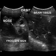 Image result for Neural Tube Defect Ultrasound
