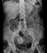 Image result for Fibroid Cysts in Uterus