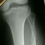 Image result for Maisonneuve Fracture