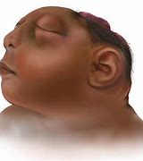 Image result for Babies with Encephalocele