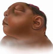 Image result for Anencephaly Prevention