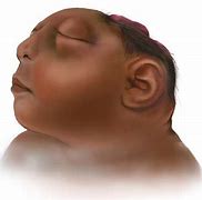 Image result for Anencephaly Side Profile