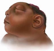 Image result for Anencephaly Miscarriage