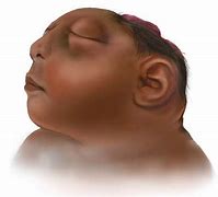 Image result for Anencephaly Brain Ultrasound