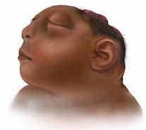 Image result for Anencephalic Baby