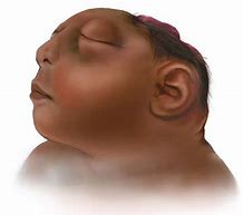 Image result for Anencephaly Photos
