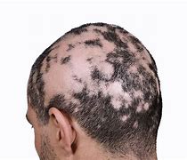 Image result for alopeciz