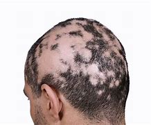 Image result for alopedia