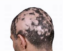 Image result for alopecja