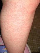 Image result for Pediatric Hives