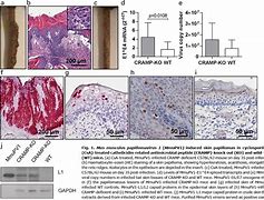 Image result for Cutaneous Papilloma