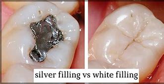 Image result for Silver vs White Filing