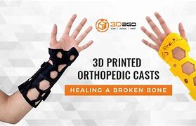 Image result for 3D Printed Cast for Broken Bones
