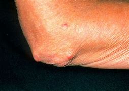 Image result for Rheumatoid Arthritis Symptoms Nodules On Skin