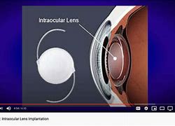 Image result for Intraocular Lens Implant Material