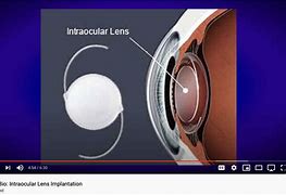 Image result for Intraocular Lens Implant CT Scan
