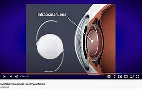 Image result for Spherical IOL Intraocular Lenses