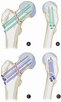 Image result for Inverted Triangle Screw Placement